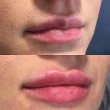 labios - hermosos - teosya - kiss - belleza- clinica - correa - navarro