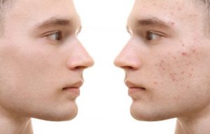 acne-solucion-borrar-manchas-crioterapia-postacne-correa-navarro-clinica-estetica-solucion